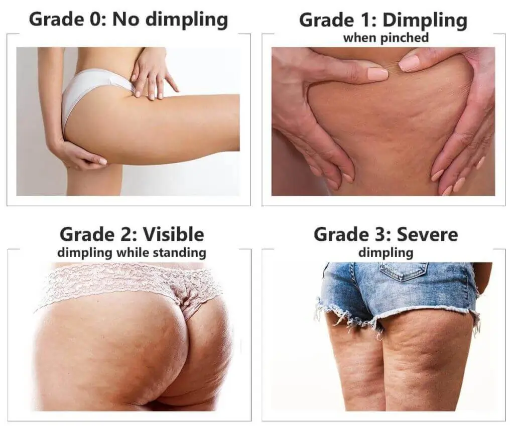 Representation of the stages of cellulite development Wiltshire